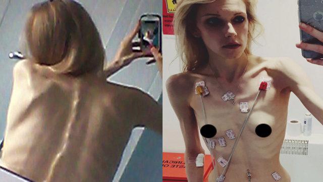 Anoreksiya hastası kızın büyük başarısı 