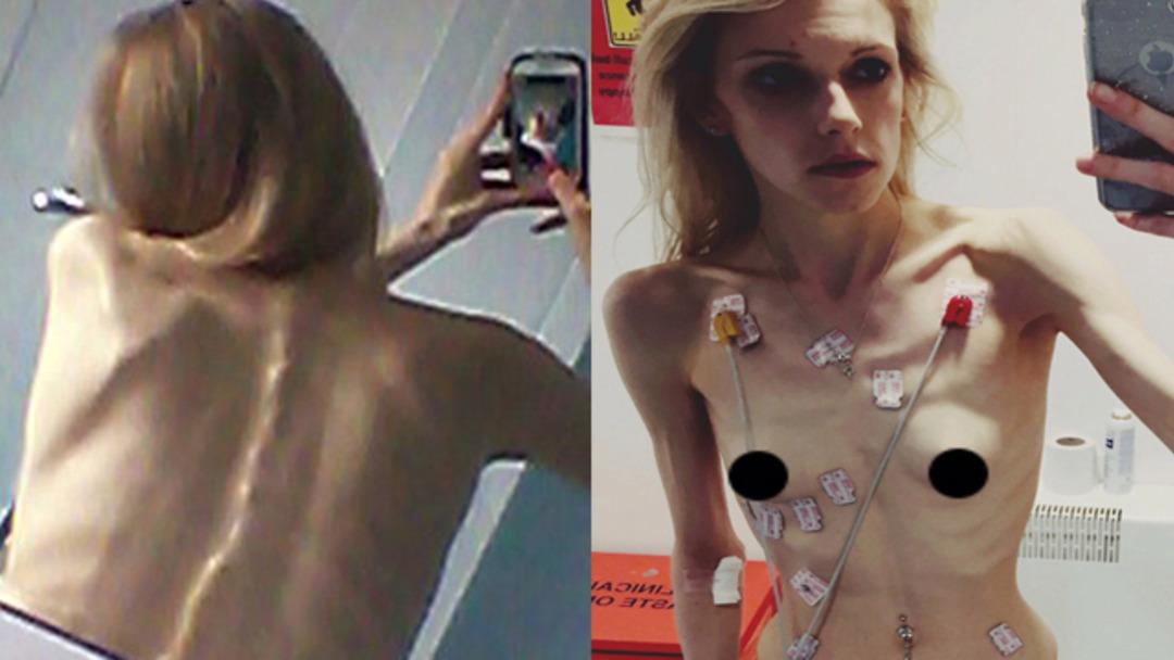 Anoreksiya hastası kızın b&uuml;y&uuml;k başarısı 