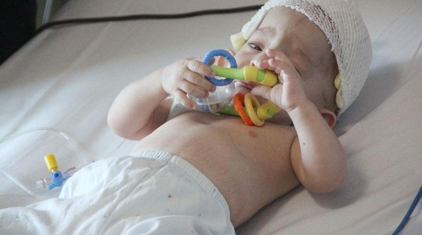 11 Aylık Bebeğe Kafa Şekil Bozukluğu Ameliyatı