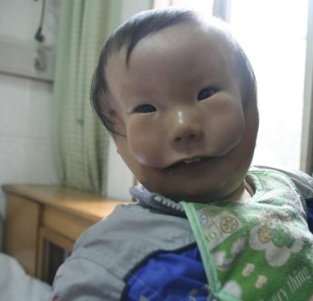 D&uuml;nyada ilk kez g&ouml;r&uuml;nen hastalık! &Ccedil;ift y&uuml;zle d&uuml;nyaya geldi