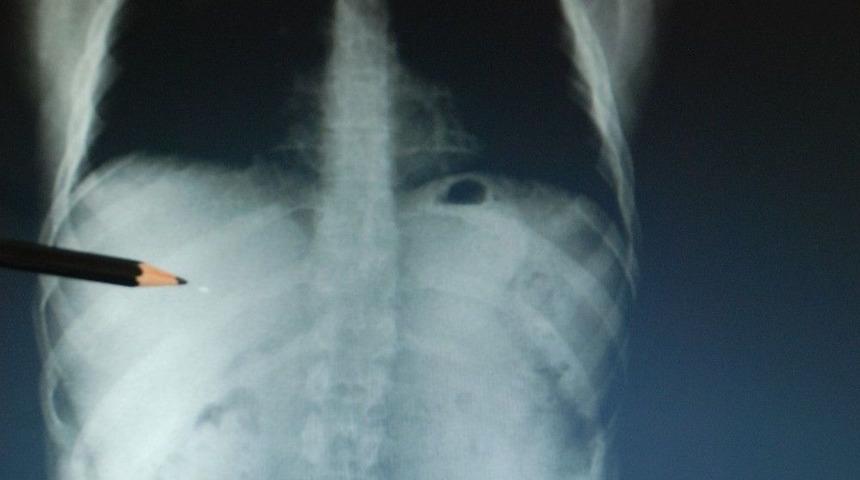 15 Temmuz Gazisi V&uuml;cudundaki Şarapnel Par&ccedil;ası İle Yaşıyor