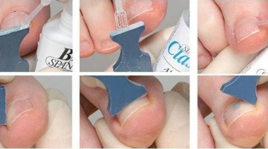 Opr. Dr. İdris Elmas, Batık Tırnak Bakımı Hakkında Bilgiler Verdi