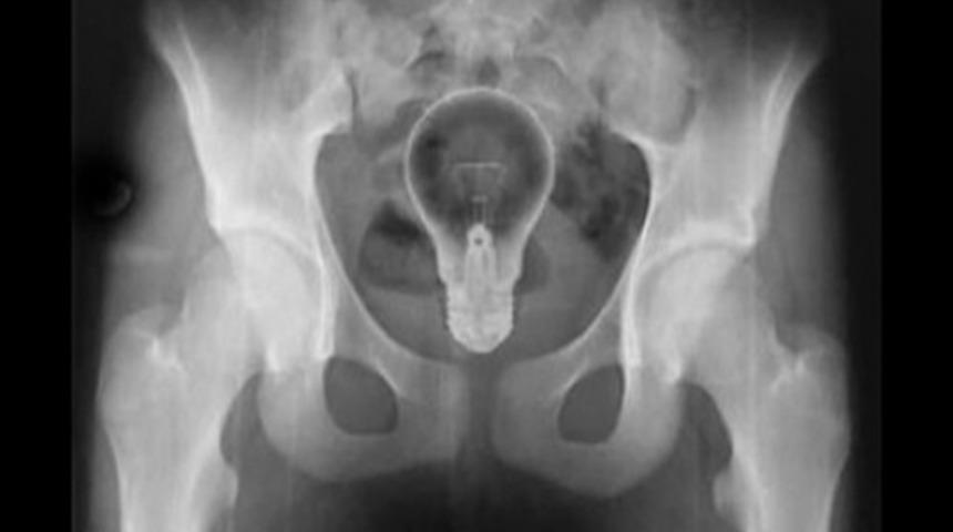 R&ouml;ntgen Filmlerinde G&ouml;z&uuml;ken En Garip Objelerden Bazıları 