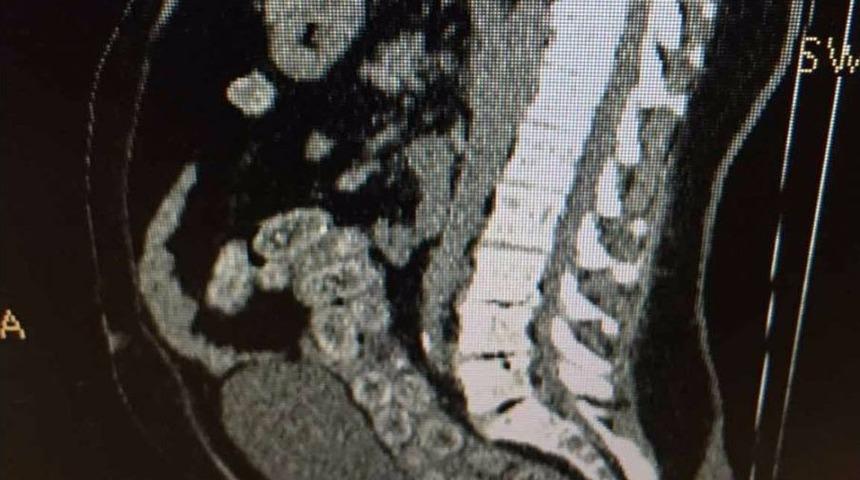 Atatürk Havalimanı’nda Ganalı Yolcunun Midesinden 95 Kapsül Kokain Çıktı