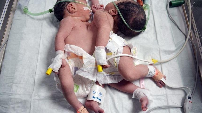 Konya’da Doğan Yapışık İkizler Ameliyatla Ayrıldı, Biri Kurtarılamadı