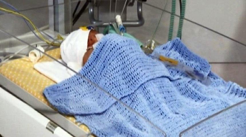 Yapışık İkizlerden Hayatta Kalan Bebeğin Tedavisi Devam Ediyor