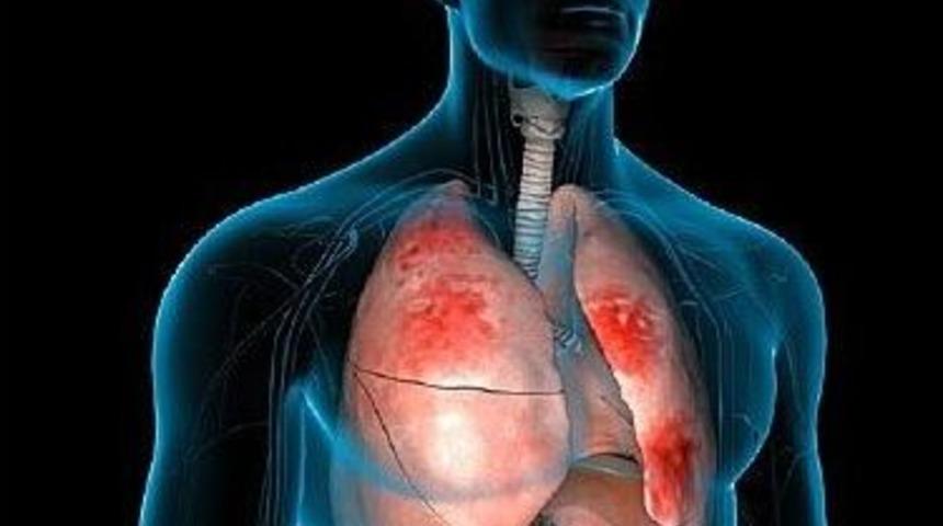 Zat&uuml;rre Hala &Ouml;l&uuml;mc&uuml;l Bir Hastalık