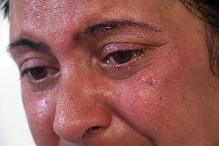 ’bembeyaz Dişlerim Olsun’ İstedi, 32 Dişinden Oldu G5