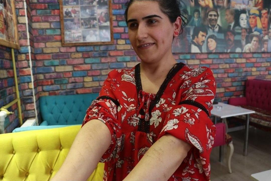 Epilasyon Tedavisine Giren Kadının V&uuml;cudunda 1. Dereceden Yanıklar Oluştu