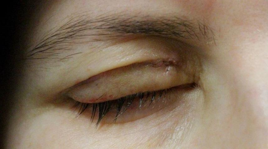 Göz Kapağını Kapatamayan Hastalar Altın İmplantla Tedavi Ediliyor