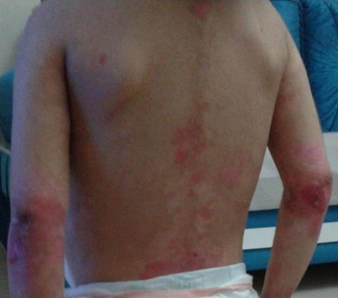 Tedavisi Olmayan Hastalığa &Ccedil;are Bulundu