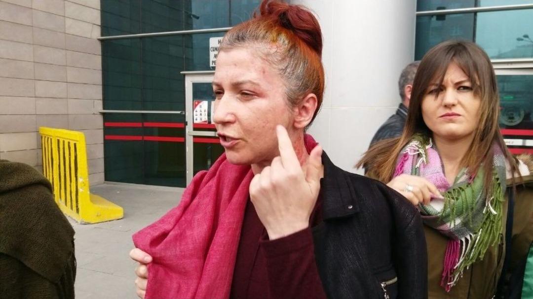 Eski Sevgilisinin Y&uuml;z&uuml;ne Yakıcı Madde Attığı Kadının Davası Başladı