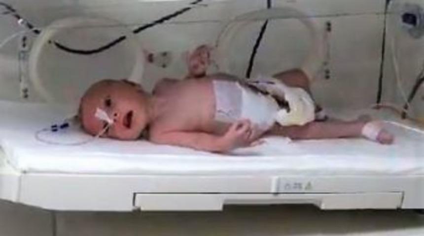 Yeni Doğan Bebeğin Karnından 1 Kilo 300 Gram Kitle &Ccedil;ıkarıldı