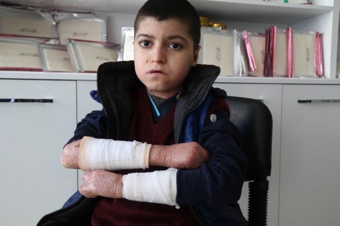 (&ouml;zel Haber) Kelebek Hastası &Ccedil;ocuklar, Kendilerine Uygun Olmayan K&ouml;p&uuml;kl&uuml; Sargı Bezini, Derilerine Yapıştığı İ&ccedil;in Kullanamıyor