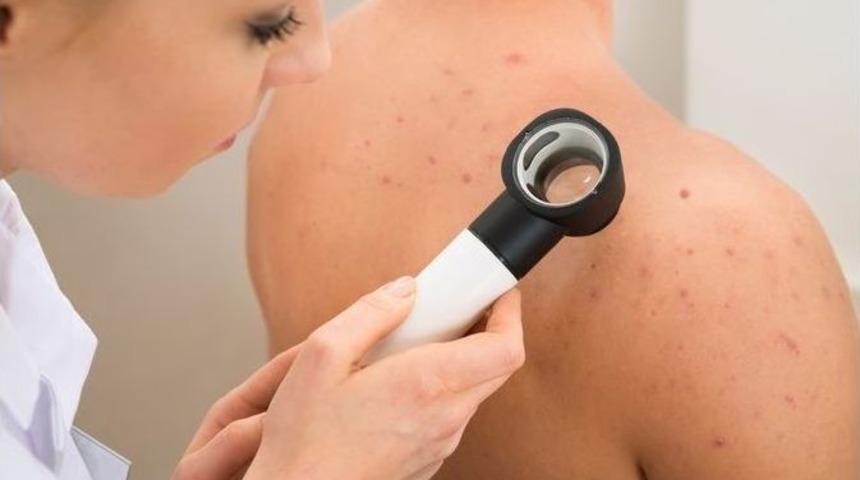 Cilt Lekelerini &Ouml;nlemede &Ouml;ncelik G&uuml;neşten Korunmak