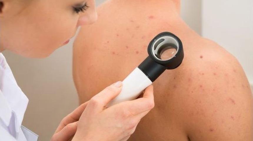 Leke Mevsimi Başladı