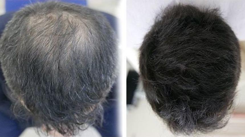 Saç Nakli Tarihe Karışıyor