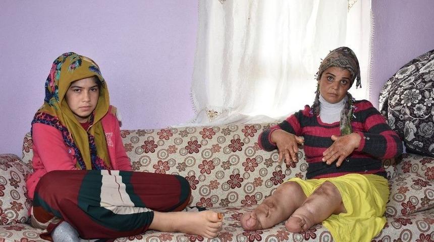 Elleri Ve Kolları Her Ge&ccedil;en G&uuml;n Eriyor