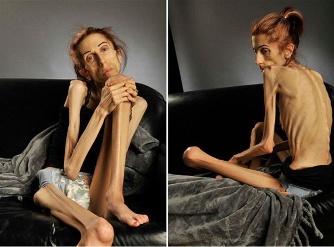 Anoreksiya hastası kadın 18 kiloya kadar d&uuml;şt&uuml;