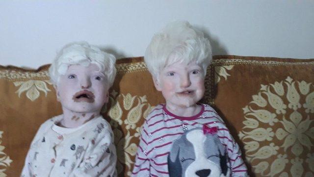 Albino Kardeşler Yardım Bekliyor