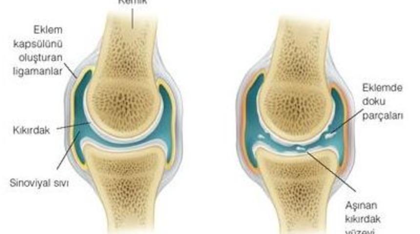 Osteoartrit (kire&ccedil;lenme), Yaşam Kalitenizi D&uuml;ş&uuml;rmesin