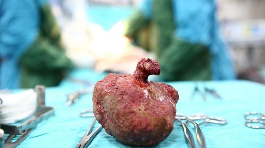 Böbreğinden 12 Santimetre Çapında Taş Çıktı