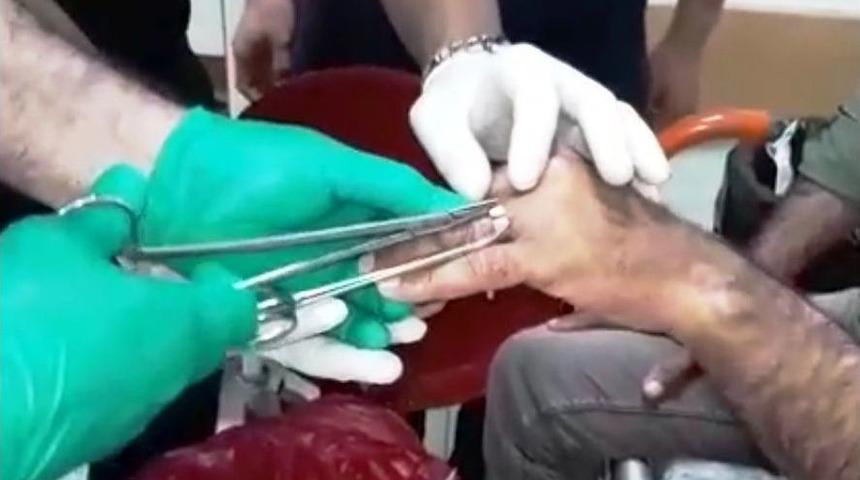 Parmağa Sıkışan Yüzük Kesilerek Çıkarıldı