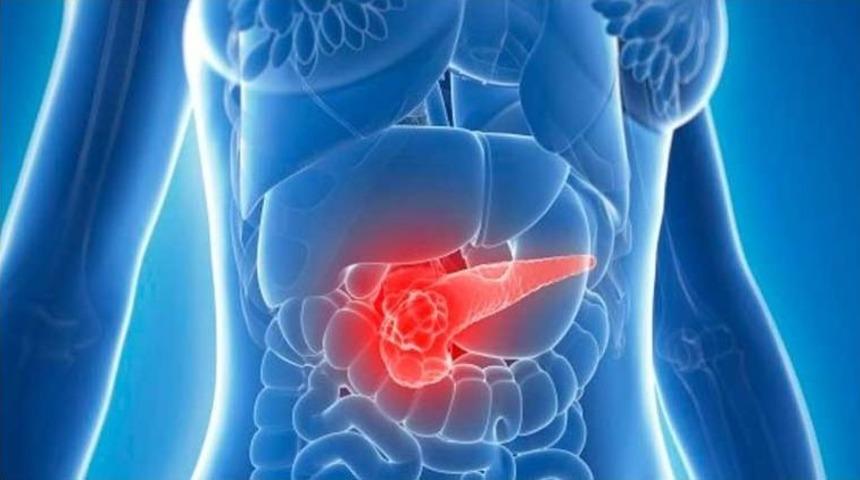 Pankreas Kanserinde Erken Teşhis &Ouml;nemli