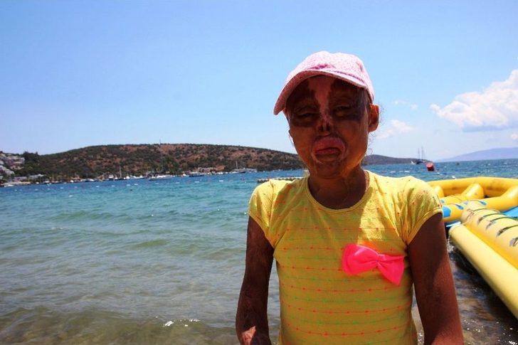 Elleri, Kulakları, Burnu Ve Saçı Olmayan Minik Zehra’nın Tek Hayali Yaşıtları Gibi Görünmek G3