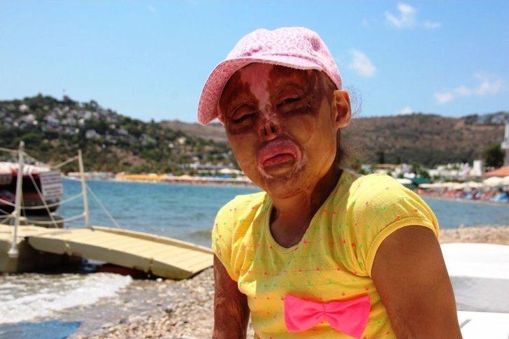 Elleri, Kulakları, Burnu Ve Saçı Olmayan Minik Zehra’nın Tek Hayali Yaşıtları Gibi Görünmek G4