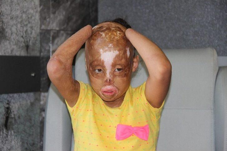 Elleri, Kulakları, Burnu Ve Saçı Olmayan Minik Zehra’nın Tek Hayali Yaşıtları Gibi Görünmek G5