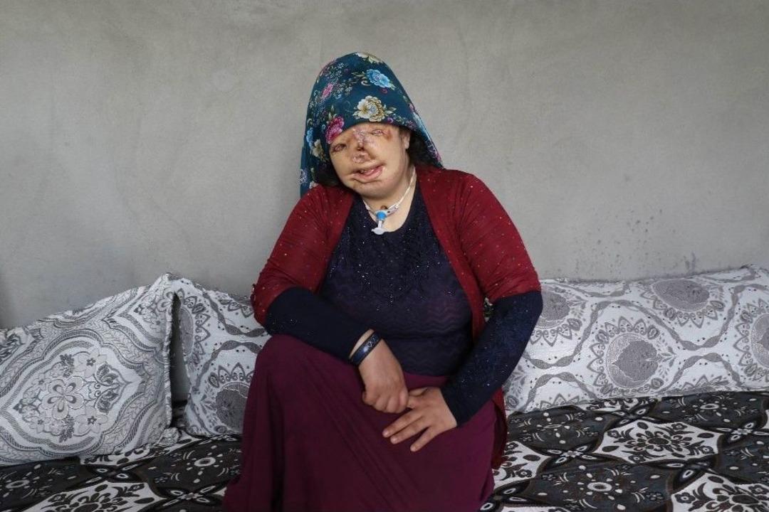 (&ouml;zel Haber) Yaşıtları Gelinlik Hayali Kuruyor, O Yanık Y&uuml;z&uuml;nden Kurtulmak İstiyor