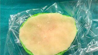 Eskişehir’de İlk Kez Üç Boyutlu Yazıcı Tekniği İle Kranioplasti Ameliyatı