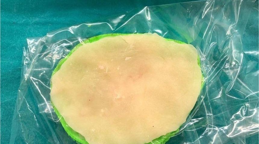 Eskişehir’de İlk Kez Üç Boyutlu Yazıcı Tekniği İle Kranioplasti Ameliyatı