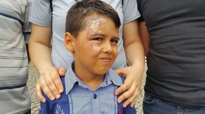 (özel Haber) Tatilden Dönen Minik Efe’nin Yüzüne Kaynar Su Döküldü