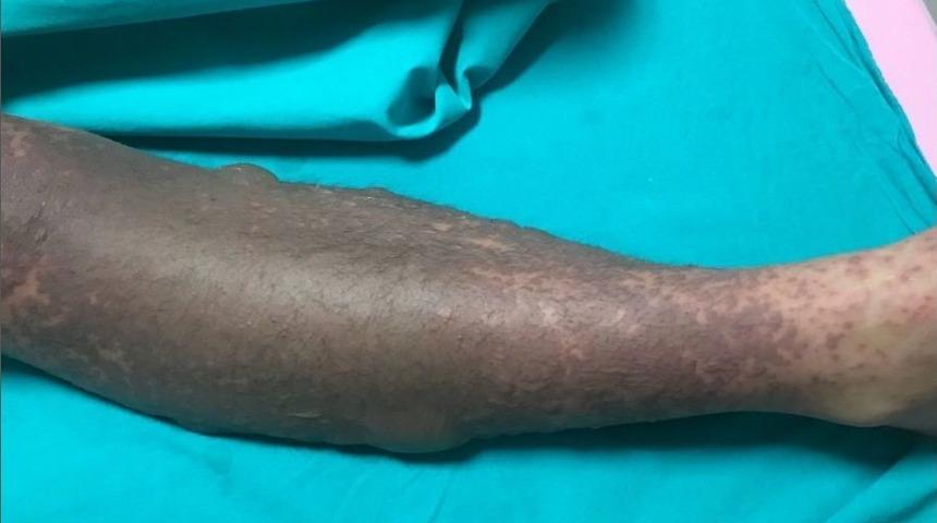 Psikiyatristin Verdiği İla&ccedil;la Yoğun Bakımlık Olan Gen&ccedil; Kızdan Sevindirici Haber