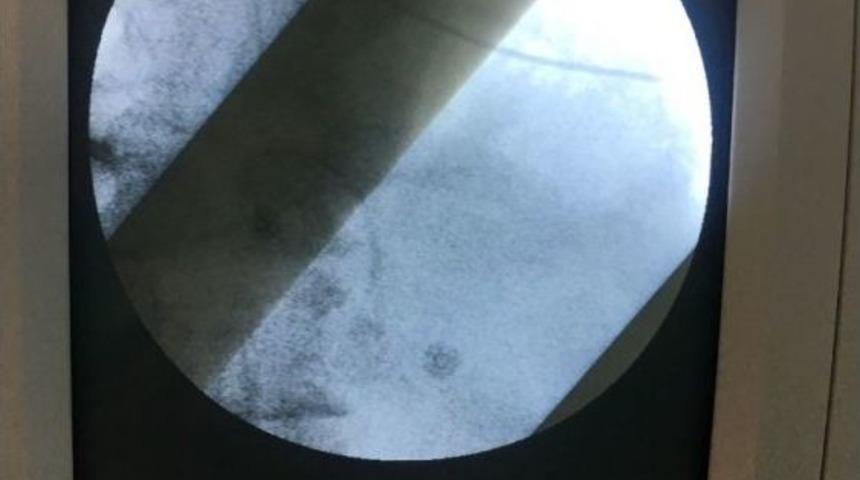 Ardahan&lsquo;da İlk Kez Kalp Pili Nakli Yapıldı