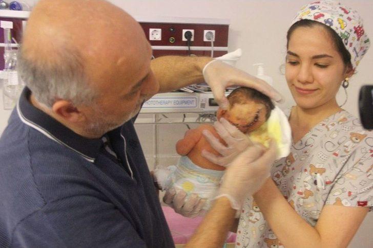 Hatay’da İki Kafalı Bebek Dünyaya Geldi G5