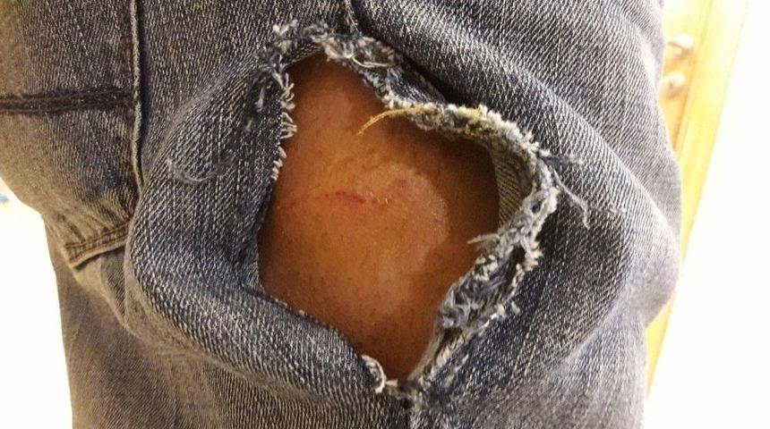 Yabancı &Ouml;ğrenciye K&ouml;pek Saldırdı