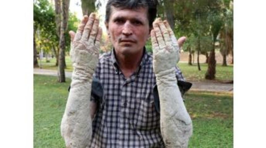 G&ouml;renlerin Korkup Ka&ccedil;tığı Sedef Hastasına T&uuml;rkiye Duyarsız Kalmadı