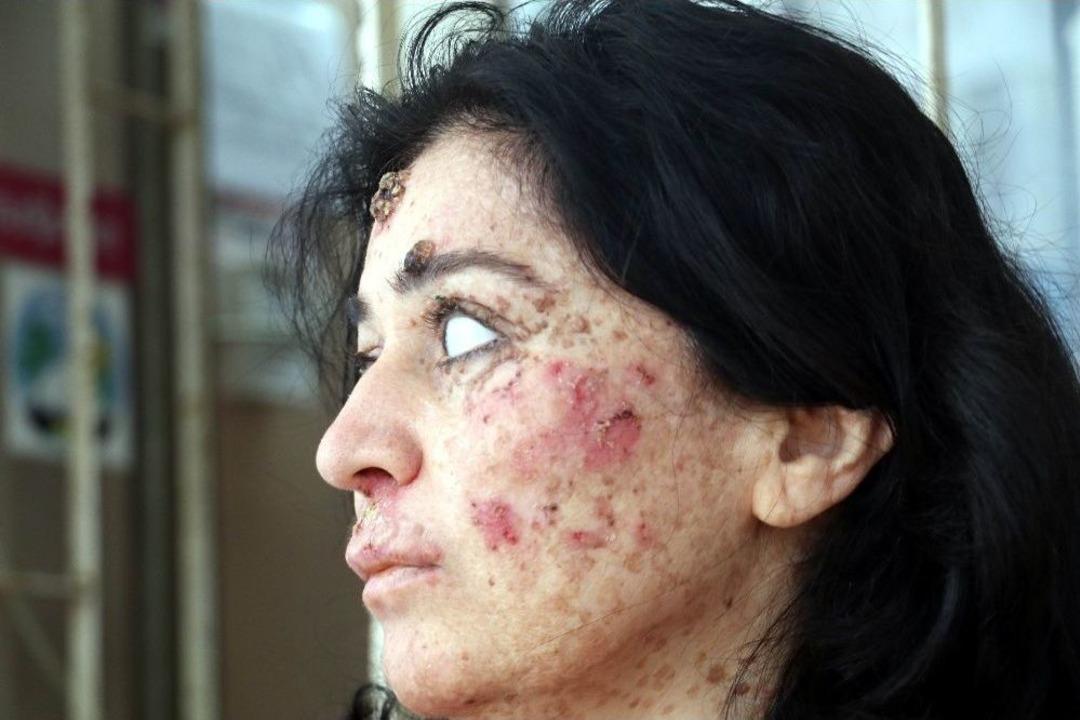 Cilt Kanseri Kadından Bilim D&uuml;nyasına Haykırış: &ldquo;deneylere Katılmak İstiyorum&rdquo;