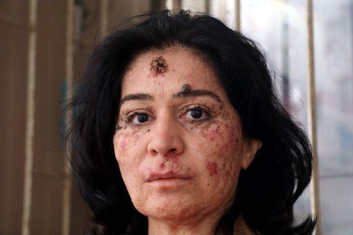 Cilt Kanseri Kadından Bilim Dünyasına Haykırış: “deneylere Katılmak İstiyorum” G3