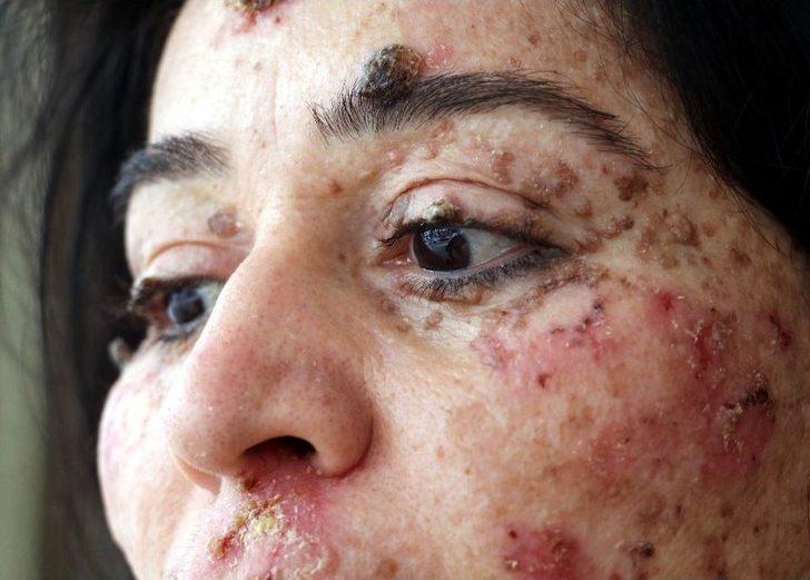 Cilt Kanseri Kadından Bilim Dünyasına Haykırış: “deneylere Katılmak İstiyorum” G1