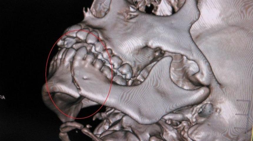 Alt &Ccedil;ene Kemiği Kırıkları
