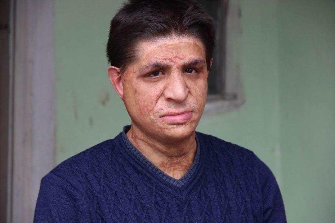 Y&uuml;z&uuml;ne Gelen Meşale Hayatını Kararttı