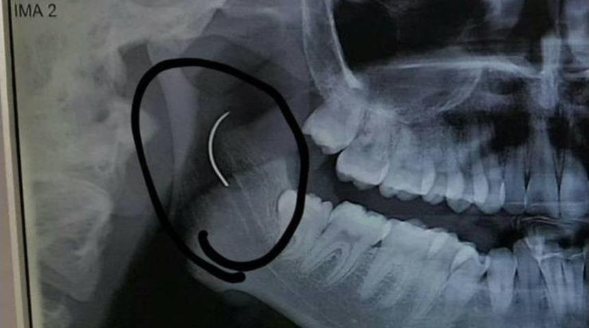 Boğazında Unutulan Ameliyat İğnesi 18 Yıl Sonra Alındı