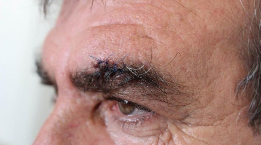 Antalya’da Yolcunun Saldırdığı Şoförün Kaşına 4, Dudağına 3 Dikiş Atıldı