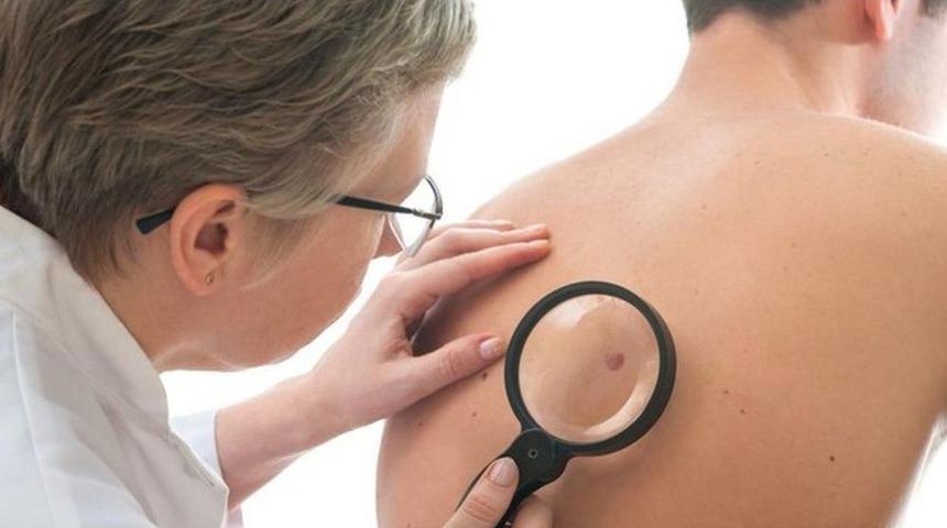 Cilt Kanserinden Korunmak İ&ccedil;in Ben Haritalama Ve Yılda Bir Kez Kontrol Şart!