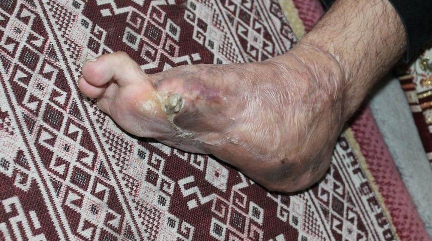 Savaşta Topuğunu Kaybeden Gence Yeni Topuk Yapıldı