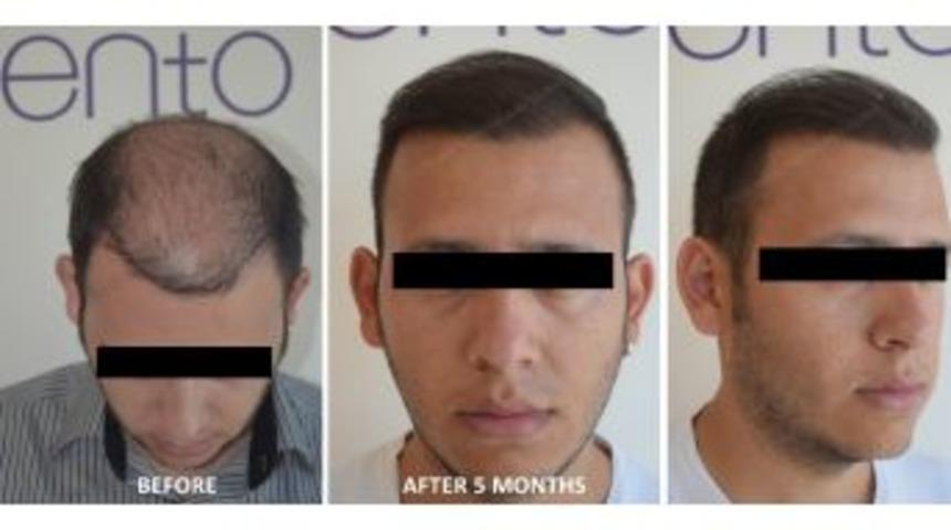 Saç Ekiminden Sonra Bunları Asla Yapmayın